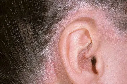 Cum începe simptome psoriazis sa recunoasca boala