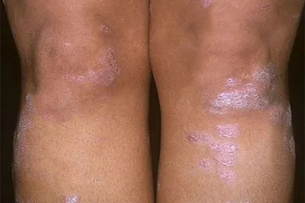 Cum începe simptome psoriazis sa recunoasca boala