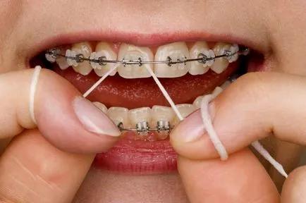 Ca atei dentare - caracteristici de aplicare