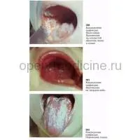 Candida infecție (partea 2)