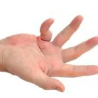 chisturi ale articulației genunchiului Baker - tratament la domiciliu de remedii populare (în comun) chisturi Baker articulației genunchiului - tratament la domiciliu remedii populare