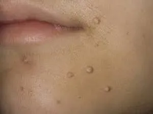 Molluscum contagiosum pe fata pentru a scăpa de imperfecțiuni cosmetice, și să nu cadă în depresie (tratamentul molluscum contagiosum) Molluscum contagiosum pe fata pentru a scăpa de defecte cosmetice și nu au primit deprimat