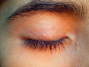 Molluscum contagiosum pe fata pentru a scăpa de defecte cosmetice și nu s-au deprimat (scoică) Molluscum contagiosum pe fata pentru a scăpa de defecte cosmetice și nu au primit deprimat
