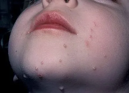 Molluscum contagiosum la copii (foto) (contagioase) Molluscum contagiosum la copii (foto)