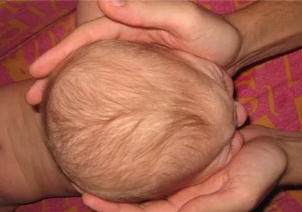 Craniostenosis - forme, cauze, simptome și tratament (tratament) Craniostenosis - forme, cauze, simptome și tratament