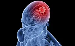 epilepsie criptogenetică - ceea ce este, de tratament, cauze, prognosticul