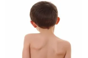 Tratamentul Profilakatika și scoliozei la copii terapie fizica, masaj, terapie fizica (pentru a trata în mod serios) Tratamentul Profilakatika și scoliozei la copii terapie fizica, masaj, fizioterapie
