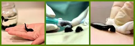 Terapia cu lipitori Hirudoterapia la domiciliu