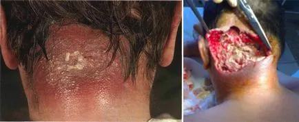 Tratamentul infecțiilor stafilococice