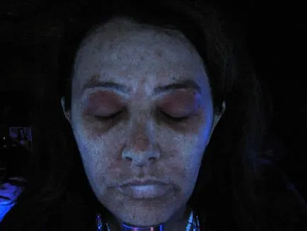 lampa Wood - neînlocuit cosmetician asistent (procese infecțioase utilizând o lampă) lampa Wood - neînlocuit cosmetician asistent