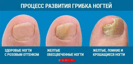 Cele mai multe metode naționale eficiente pentru tratarea unghiilor ciuperca