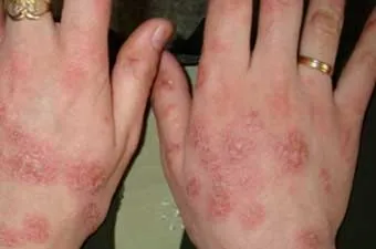 cosuri mici pe mâinile cauzele, tratamentul, prevenirea