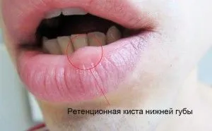Pe partea interioară a buzei inferioare a apărut provoacă un cucui