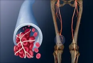 Violarea membrelor inferioare simptome circulatorii, tratament, consecințe, prevenirea