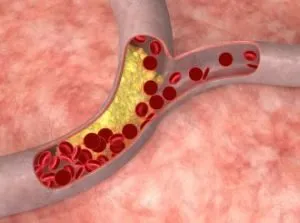 Violarea membrelor inferioare simptome circulatorii, tratament, consecințe, prevenirea