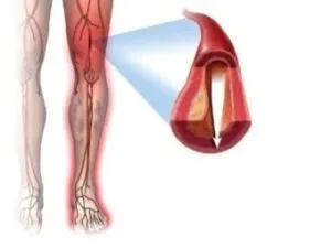 Violarea membrelor inferioare simptome circulatorii, tratament, consecințe, prevenirea