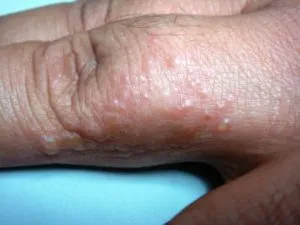 În mâinile umflaturi mici de acolo și mâncărime
