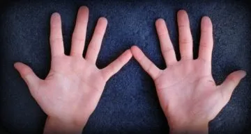 Calusurile pe mâinile cauze ale simptomelor, semne, tratament și diagnostic (remediu pentru bătături la mâini) Calusurile pe mâinile cauze ale simptomelor, semne, tratament și diagnostic