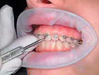 Complicațiile după acolade sunt toate despre aparat dentar, ortodontie (după) Complicațiile după acolade sunt toate despre bretele, ortodonție