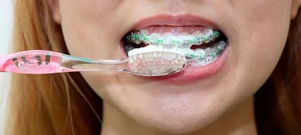 Complicațiile după acolade sunt toate despre aparat dentar, ortodontie (fie cauza de eșec al tratamentului) Complicațiile după acolade sunt toate despre bretele, ortodonție