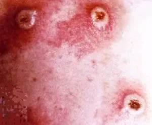 infecții periculoase în special