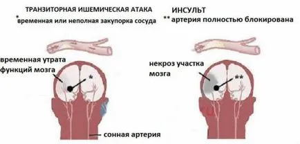 Din ceea ce este un accident vascular cerebral si de ce apare