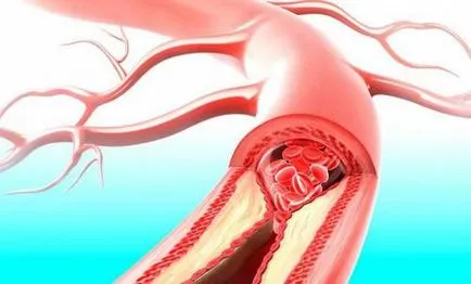 Din ceea ce este un accident vascular cerebral si de ce apare