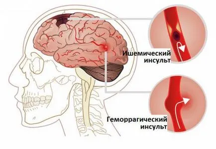 Din ceea ce este un accident vascular cerebral si de ce apare