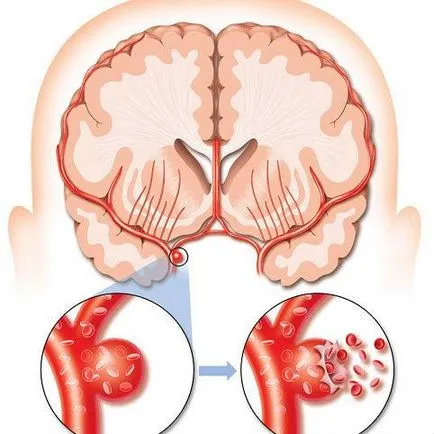 Din ceea ce este un accident vascular cerebral si de ce apare