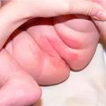 dermatita de scutec la sugari - cauze, tratament