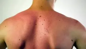 De ce sunt alunite noi pe corp - există un pericol