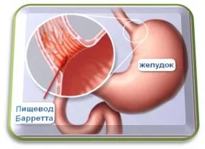simptome esofag Barrett, medicamente, dieta, chirurgie (esofag) Esofagul simptome, tratament, dieta, chirurgie Barrett