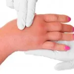 De ce crapa pielea de pe mâini și se usucă, și ce să facă în cazul în care acesta este uscat