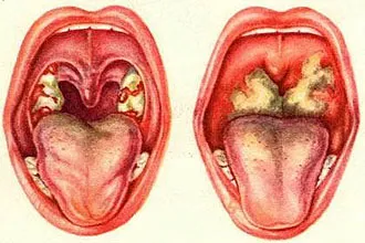 De ce inflamate ganglionilor limfatici din spatele urechilor - principalele motive (ganglioni limfatici) De ce inflamate ganglionilor limfatici din spatele urechilor - principalele motive