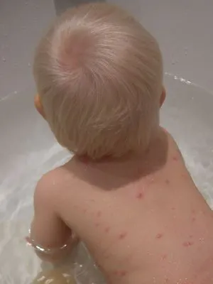 Acneea este un copil al soiului și cauzele