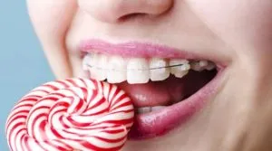 tracțiune din cauciuc pentru aparat dentar - de ce și cum să le pună pe (tracțiune) tracțiune din cauciuc pentru aparat dentar - de ce și cum să le pună pe
