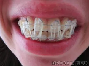 tracțiune din cauciuc pentru aparat dentar - de ce și cum să le pună pe (aparat dentar) tracțiune din cauciuc pentru aparat dentar - de ce și cum să le pună pe