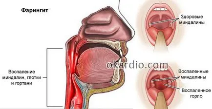 Reumatism a inimii, care este, simptome și tratament, prognosticul (a) Reumatism a inimii, care este, simptome și tratament, prognostic