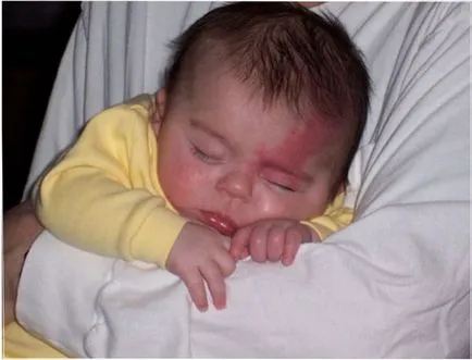 Birthmark nou-născut în cazul în care este periculos (nou-născut) Birthmark nou-născut în cazul în care este periculos