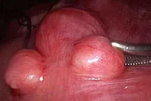 Simptome, semne și tratamentul fibrom uterin (tratament) Simptome, semne și tratamentul fibrom uterin