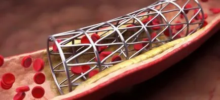 Stentarea vaselor inimii, coronariene stenting - cât de multe vii după o intervenție chirurgicală (artere) Stentarea vaselor inimii, arterelor coronare stenting - cât de mulți trăiesc după o intervenție chirurgicală