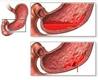 deoarece procesul de coagulare a sângelui are loc ca de coagulare a sângelui (coagulare) Coagularea sângelui ca are loc un proces de coagulare a sângelui