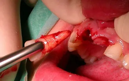 extracții dentare - cat timp doare gingiile și gaura