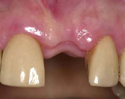extracții dentare - cat timp doare gingiile și gaura