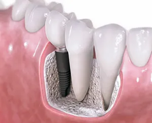Instalarea implanturi dentare pro și contra vizualizări Preț (implanturi) Instalarea de implanturi dentare și contra, tipuri, preț