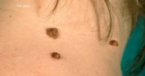 mol Convex - imagine, cauze tratamente de pericol (convexe) Convex mol - imagine, cauzele, tratamente de risc