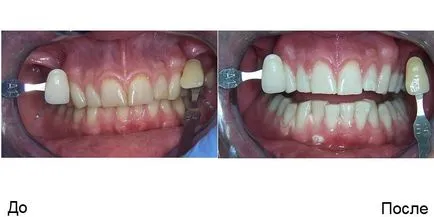 albirea dintilor chimice care este, pret, recenzii