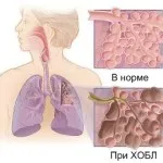 Zadyhayus tuse și nu poate inhala cauze de aer (tuse) Sufocare tuse și nu pot respira cauzele de aer