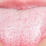 Limba acoperită cu floare cauze albe, ce să facă