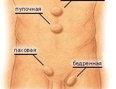 Terenul copilului hernie si nu numai